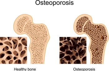 osteo-image-1.jpg